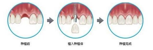 單顆牙齒種植