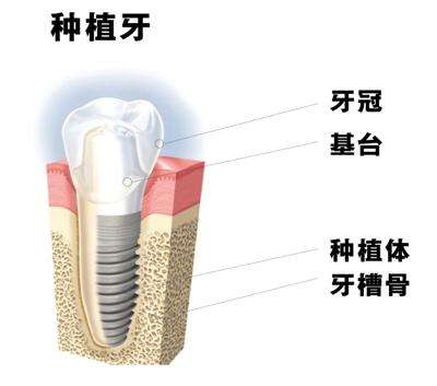 口腔種植牙結果怎麽(me) 樣