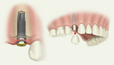種植牙後一般會(hui) 疼幾天
