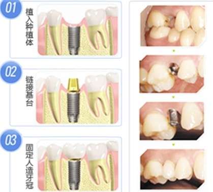 種植牙手術痛苦嗎