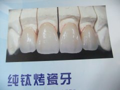 純鈦烤瓷牙的費用是多少