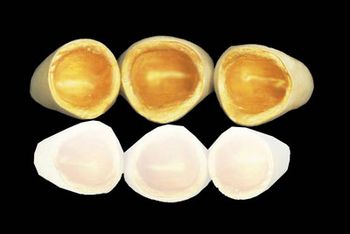 烤瓷牙能用多久