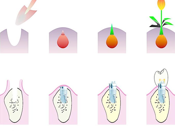 韓國種植體(ti) 價(jia) 格