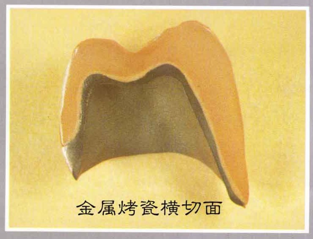 烤瓷牙有幾種
