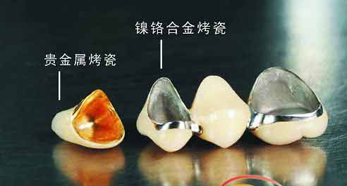 烤瓷牙圖片