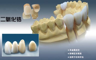 烤瓷牙平均使用時間8~10年左右