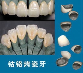鈷鉻烤瓷牙