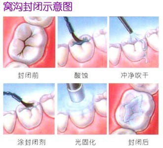 兒(er) 童蛀牙後做窩溝封閉有用嗎