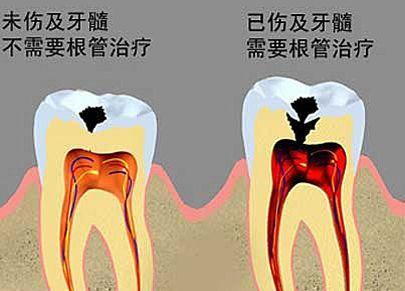 根管治療牙神經痛