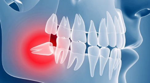 冠周炎拔牙費用