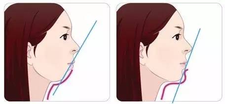 牙齒矯正的危害