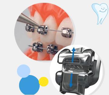 自鎖托槽牙齒矯正的優(you) 點