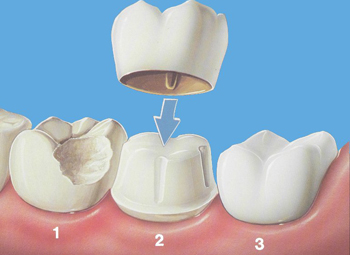 牙齒磨損怎麽(me) 修複