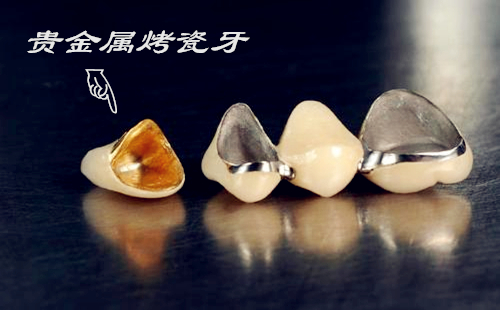 貴金屬烤瓷牙的種類