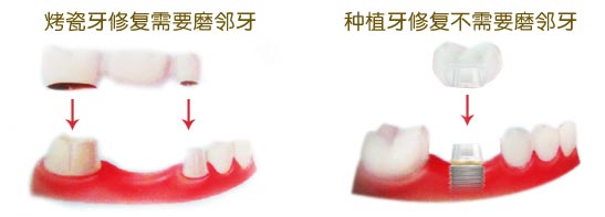 種牙與(yu) 烤瓷牙哪個(ge) 好