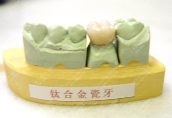 鈦合金烤瓷牙多少錢