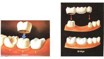 烤瓷牙製作過程