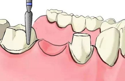 烤瓷牙怎麽(me) 做的