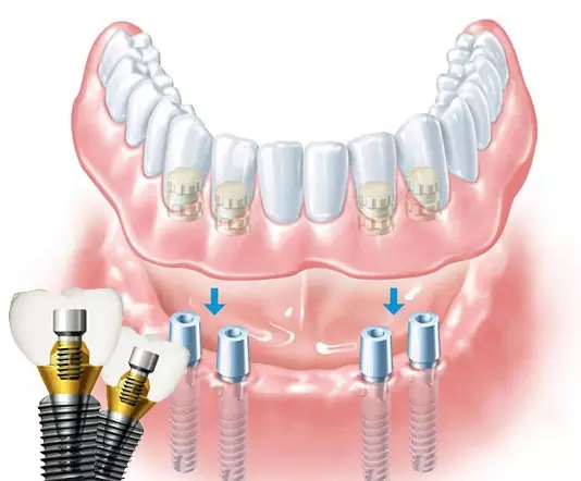 牙齒多顆缺失怎麽(me) 種植牙