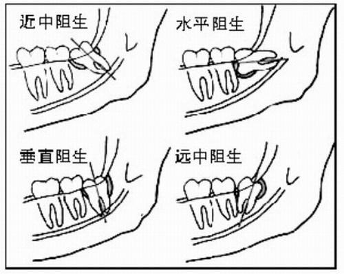 盡頭牙能拔嗎