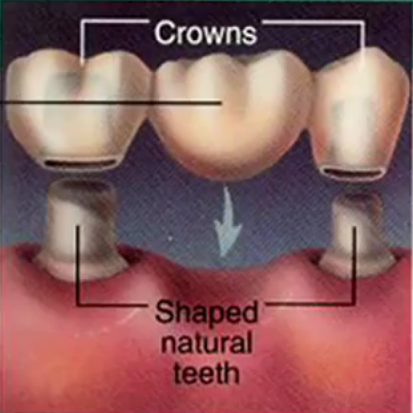 牙齒烤瓷冠多少錢