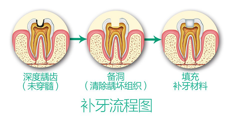 深圳補牙價(jia) 格表