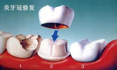 牙冠價(jia) 格