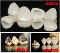 牙冠的分類