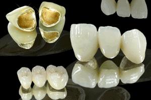 烤瓷牙套是什麽(me) 多少錢