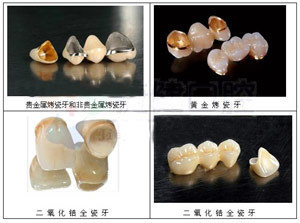 烤瓷牙和全瓷牙的區別