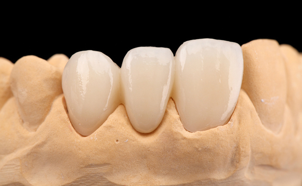 門牙貼麵多少錢一顆