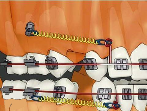 牙齒矯正打骨釘疼嗎