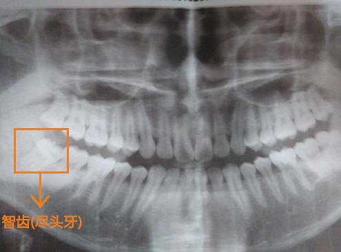 長智齒牙齦腫痛