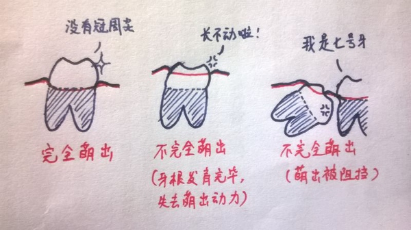 孩子長智齒疼