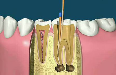 急性牙髓炎的治療方法