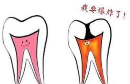急性牙髓炎的症狀表現