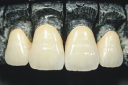 純鈦合金烤瓷牙的價(jia) 格