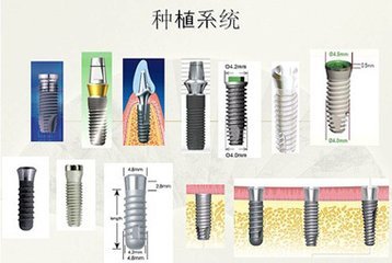 種植牙瑞典NobelGuide和瑞士ITI哪個(ge) 好