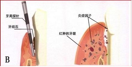 洗一次牙齒的費用