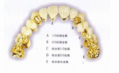 黃金烤瓷牙價(jia) 格多少
