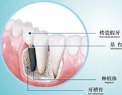 牙齦萎縮做種植牙