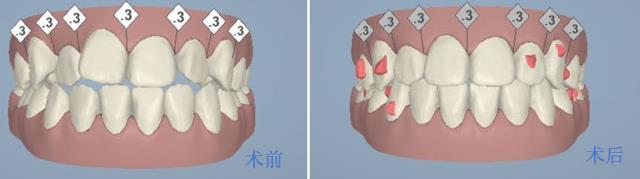 隱形牙箍價(jia) 格