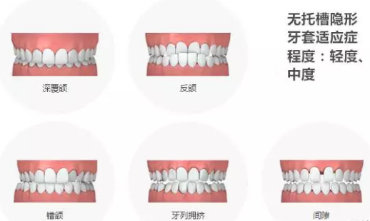 哪些牙齒更適合做隱形牙套矯正