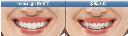  隱形牙套與(yu) 普通牙套價(jia) 格**