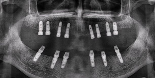 種植滿口牙需要多少錢
