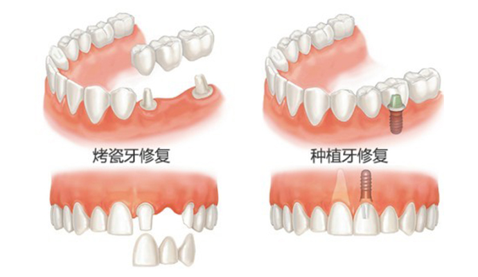 深圳口腔醫院鑲牙多少錢