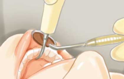 夏天做種植牙需要注意什麽(me) 