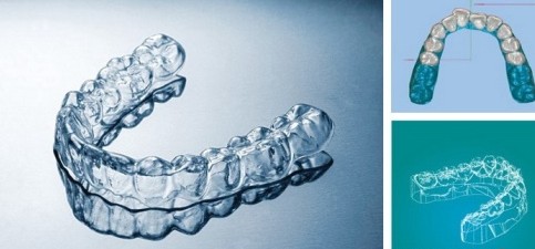 成人校正牙齒的特點