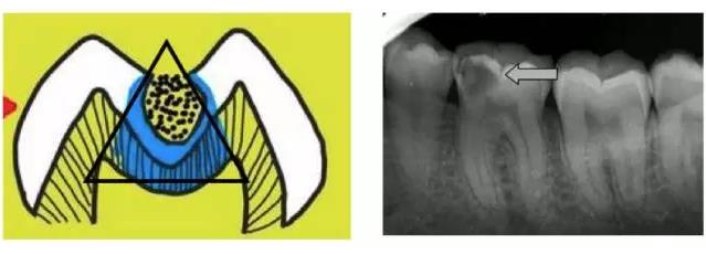補牙怎麽(me) 補