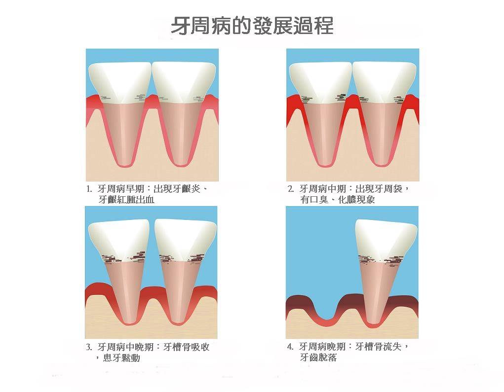 牙周病圖片